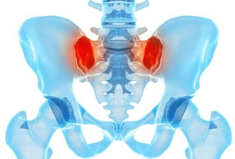 Viêm khớp cùng chậu là tình trạng viêm sưng xảy ở một hoặc nhiều khớp giữa xương cột sống và xương chậu