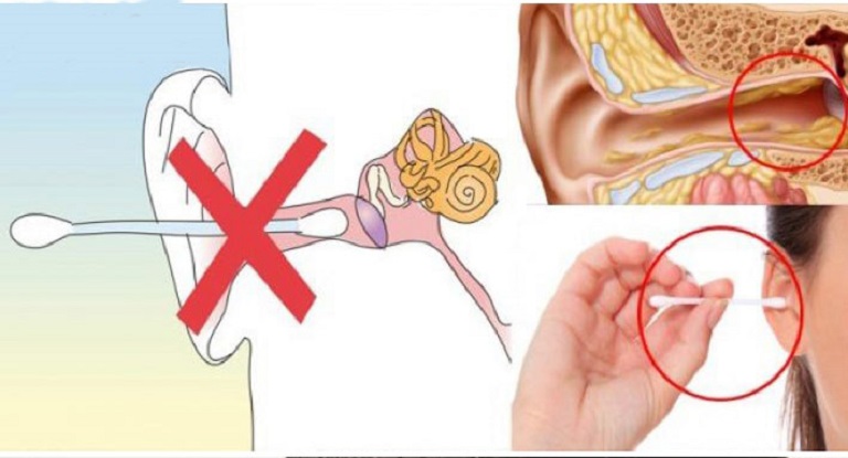 Không dùng tăm bông ngoáy tai nhiều lần để tránh tổn thương niêm mạc