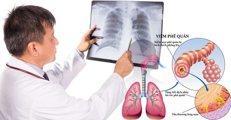 Chụp X - quang và chụp CT cho phép chẩn đoán chính xác tình trạng phổi