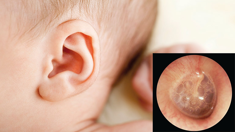 Chảy dịch mủ từ tai là một trong những biểu hiện bệnh
