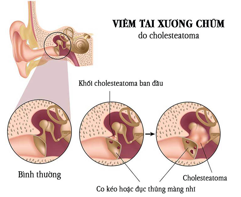 Cholesteatoma là một tổ chức mọc lạc vào tai giữa, dẫn đến nhiễm trùng tái phát