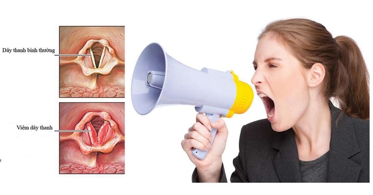 Một trong những nguyên nhân gây viêm thanh quản mất tiếng là do la hét quá nhiều