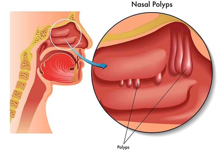Polyp mũi là biến chứng của bệnh viêm xoang gây khó thở